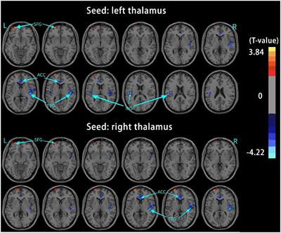 Altered functional connectivity of the thalamus in primary angle-closure glaucoma patients: A resting-state fMRI study